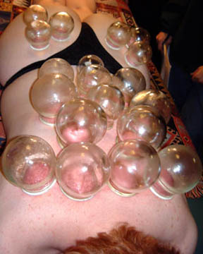 a full cupping in progress